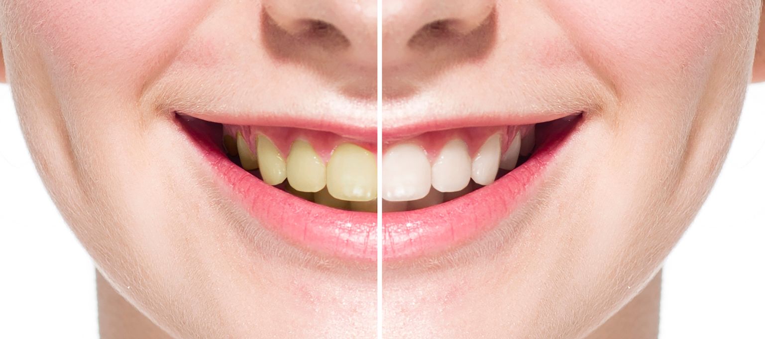 Dental veneers pros and cons