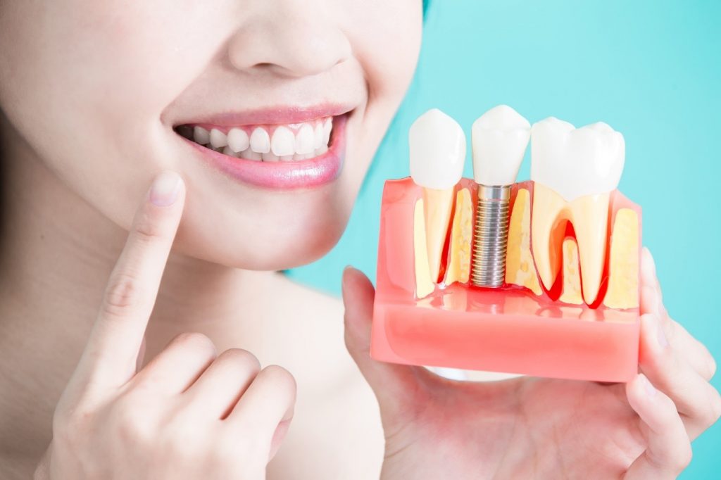 a-guide-to-average-cost-of-teeth-implants-the-cost-trending-us