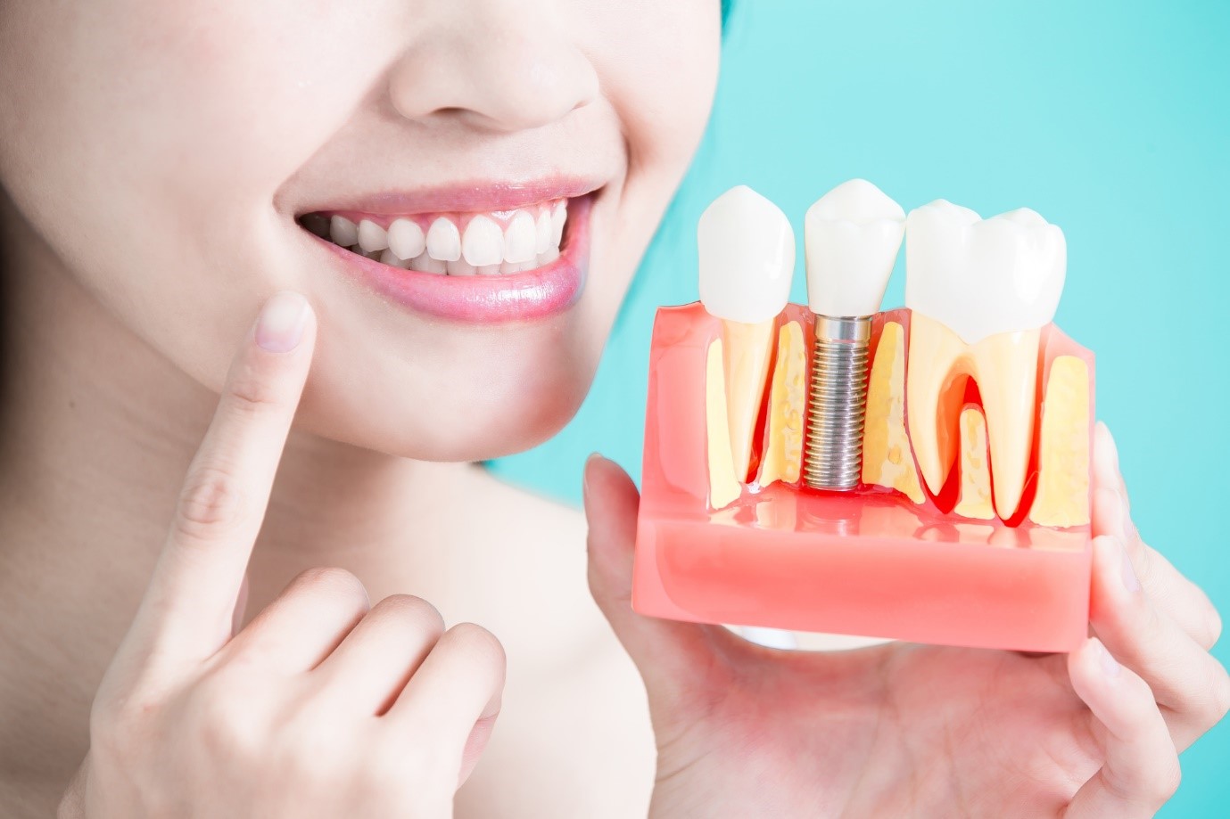 How much do teeth implants cost