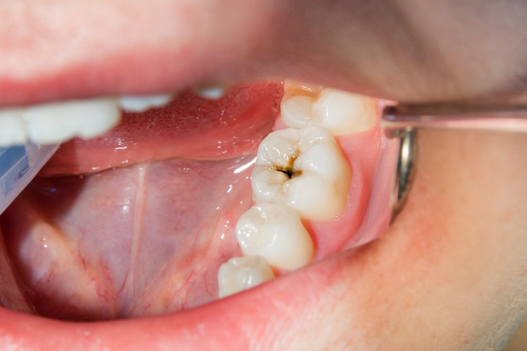 How Much Does It Cost to Fill a Cavity? » Trending Us